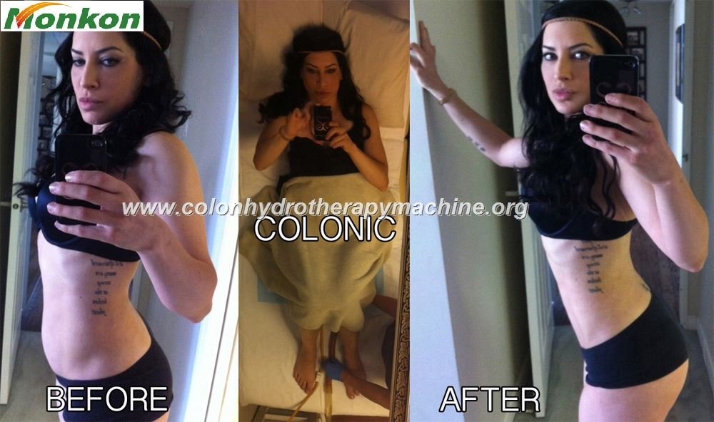 Hidroterapia de Colon