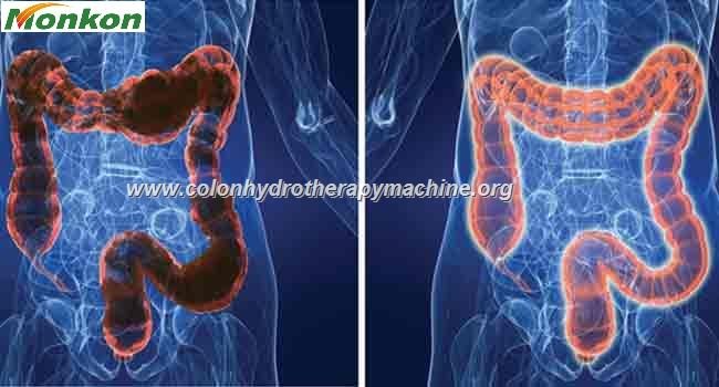 Hidroterapia de Colon