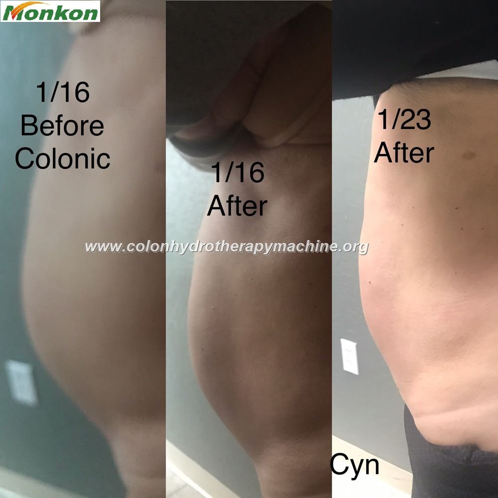 Hidroterapia De Colon Monterrey