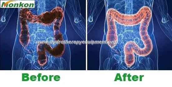 Hidroterapia de Colon Pachuca: Guía Completa sobre Tratamiento y Equipos Profesionales 3 Antes y después de tratamiento de hidroterapia de colon mostrando beneficios