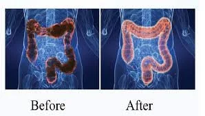 ¿Para qué sirve un "15 días cleanse" y cómo evaluarlo desde Aguascalientes (guía para asesores de salud)? 10 ¿Para qué sirve un "15 días cleanse" y cómo evaluarlo desde Aguascalientes (guía para asesores de salud)? — How Much Does Colonic Hydrotherapy Cost (82).jpg