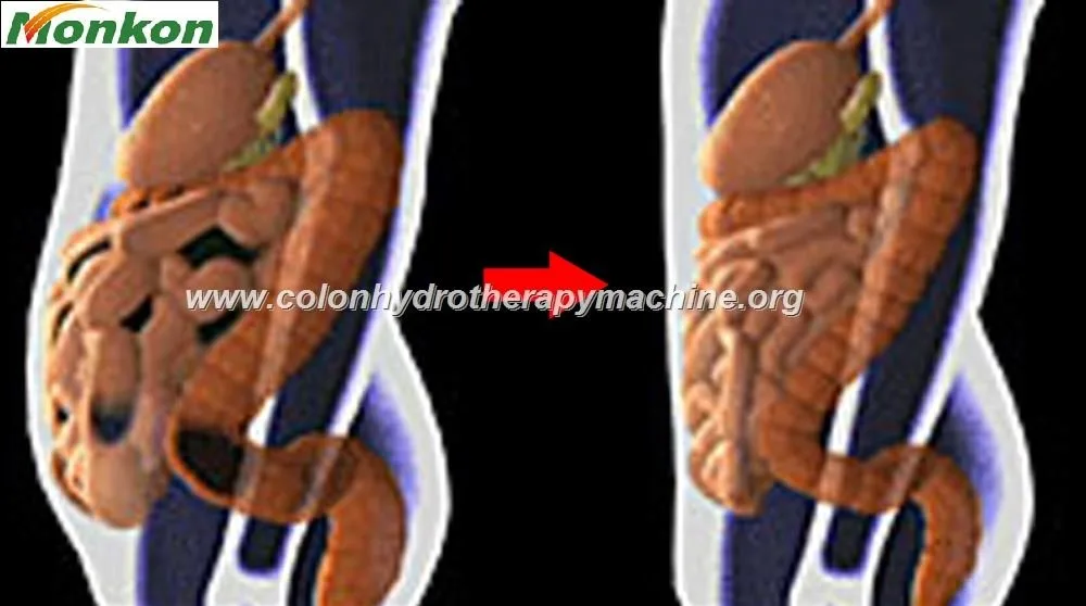 Cómo elegir un proveedor fiable de cama para hidroterapia de colon al por mayor en México — Equipo para Hidroterapia de Colon MAIKONG (85)